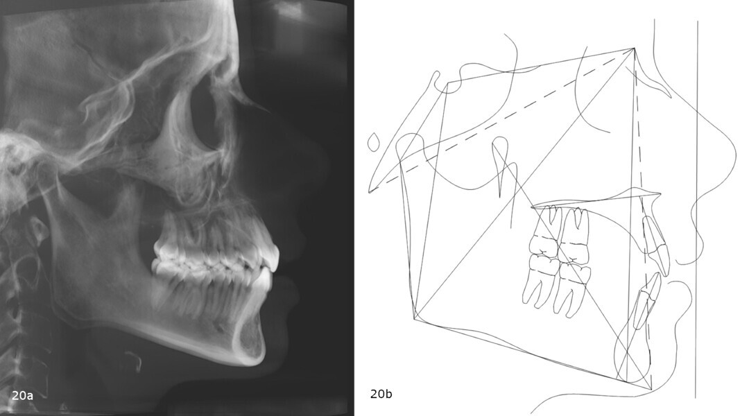 Figs. 20a & b: Pretreatment cephalometric radiograph (a) and tracing (b).