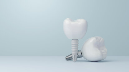 Implants dentaires : une étude suggère que la zircone induit une activation immunitaire plus importante en phase précoce