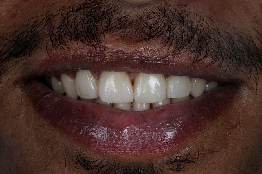 Fig 24: Final smile