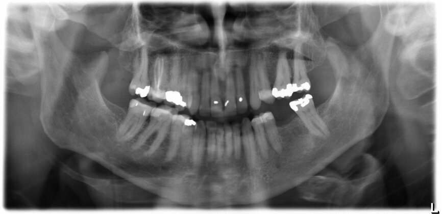 Fig. 1: Panoramic radiograph confirming the well-maintained anatomical conditions one year after tooth extraction.
