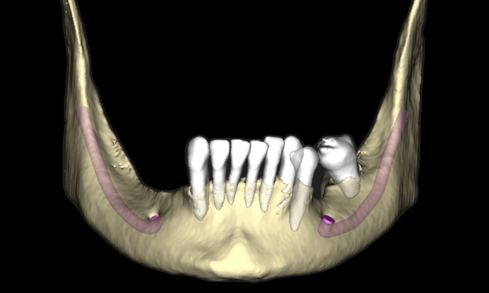 Figs. 16–28: The treatment workflow included the extraction of hopeless teeth, implant planning and positioning, and surgical guide fabrication.