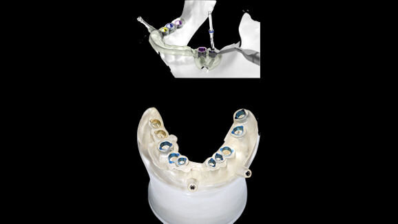Webinar addresses digital workflow in implantology