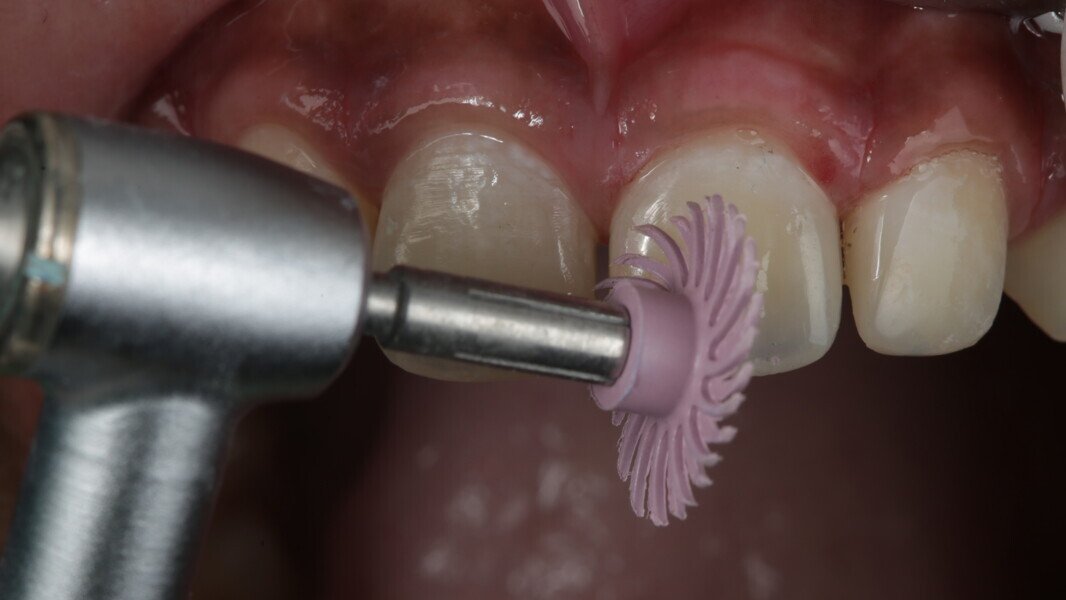 Fig 37: Diamond-impregnated polisher was used for surface refinement at high speed with irrigation.