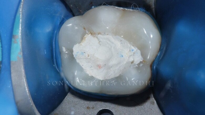Fig 2: Isolation achieved with Rubber Dam 