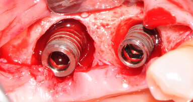 Trattamento di periimplantite: rigenerazione con l’utilizzo di un sostituto a lento riassorbimento