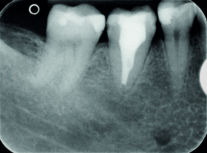 Fig. 16c: Radiograph at the 11-year recall.
