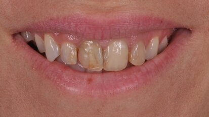 BEST.FIT: A hybrid technique for efficient and aesthetic restoration of anterior teeth