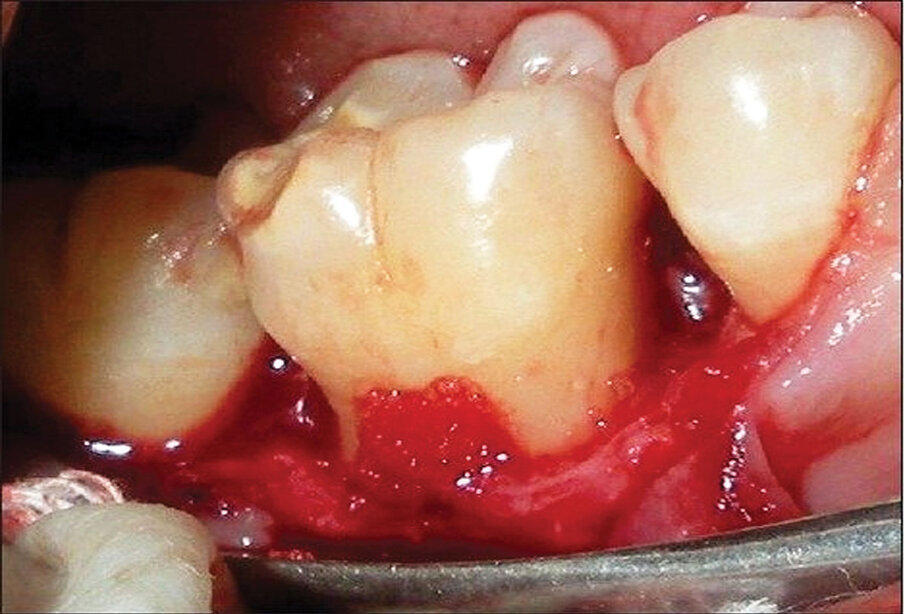 Fig. 8: Placement of ‘gummy bone’ into a furcation defect, allowing the graft to remain where placed and avoid dispersement potential typically observed with particulates rehydrated with saline.