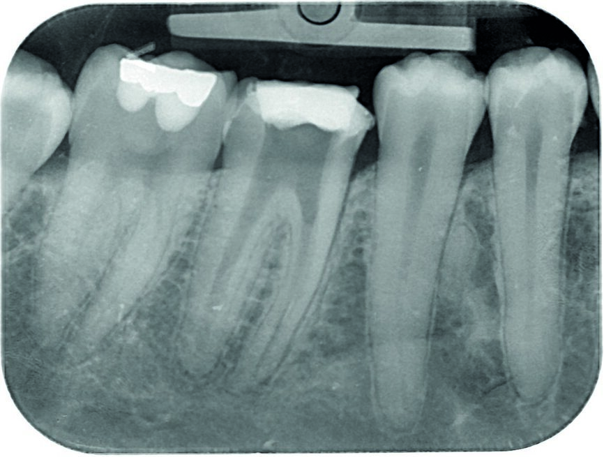 Fig. 2: Control radiograph to assess the removal of a separated lentulo