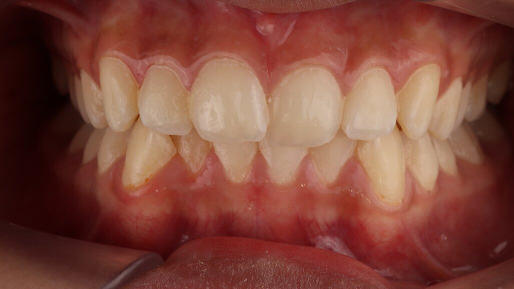 ClearX teen smile transformation
