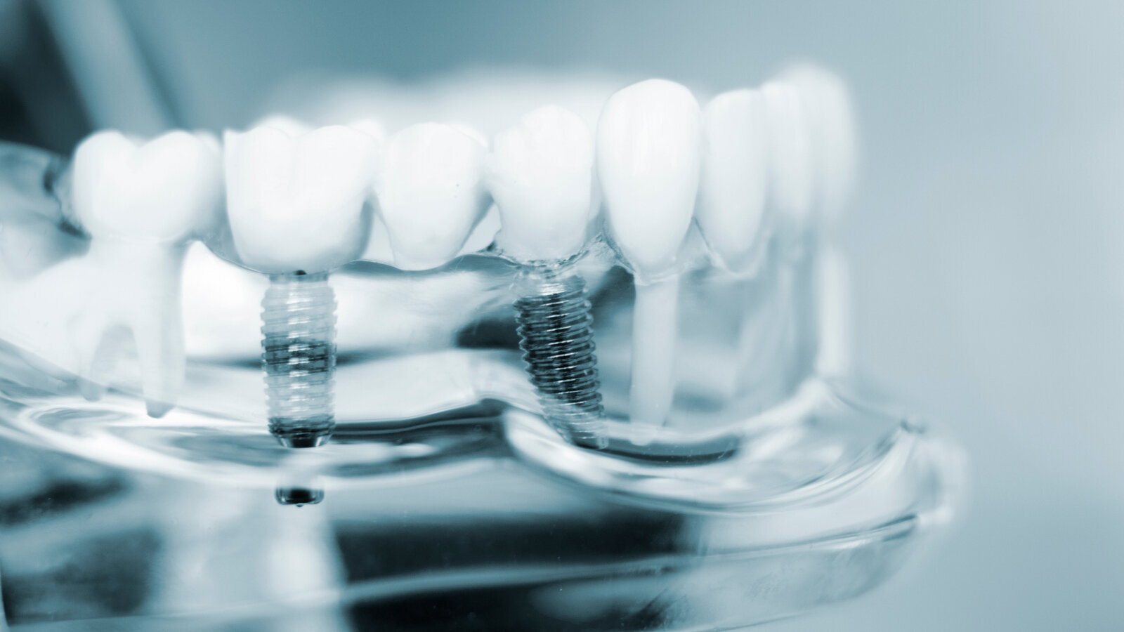 Istraživači kombinuju znanja iz ortopedije i stomatologije za poboljšanje dugovečnosti implantata