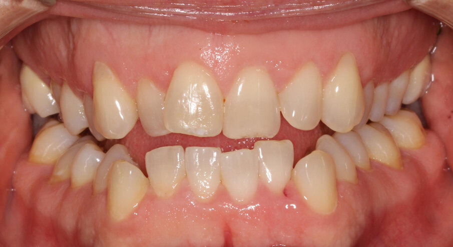 Pre-treatment