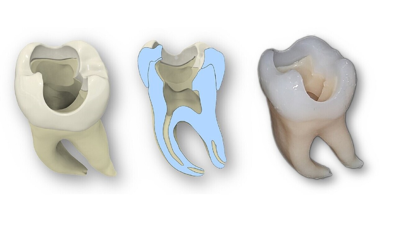 Construction of a practice tooth based on the reconstruction of a real tooth. From left: overview of the entire tooth consisting of enamel and dentine, cross-section of the tooth, complete tooth produced using 3D printing. (Image: Christian Höhne/UKW)