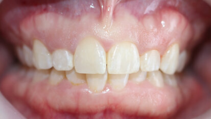 Aesthetic crown lengthening, exostosis removal and veneer restorations