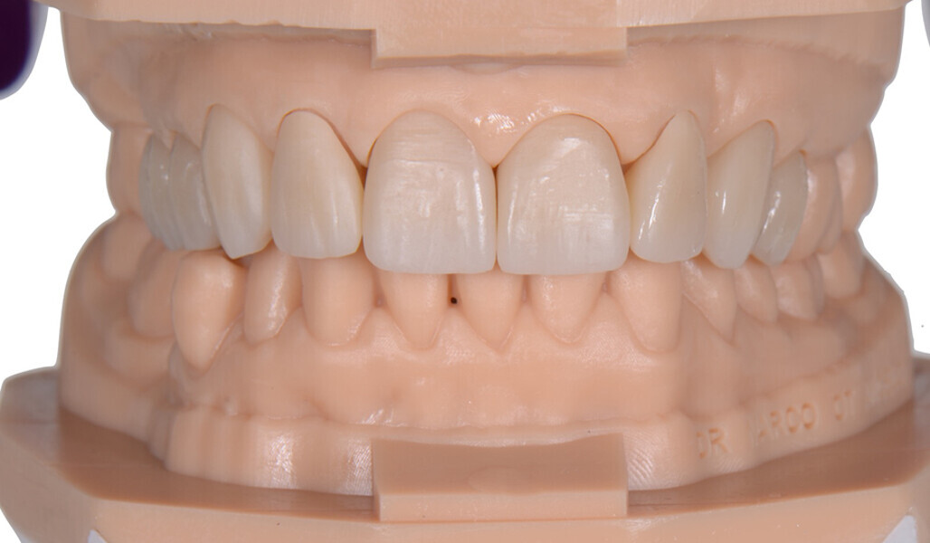 Fig. 14: Frontal view of the sintered restorations on the resin models.