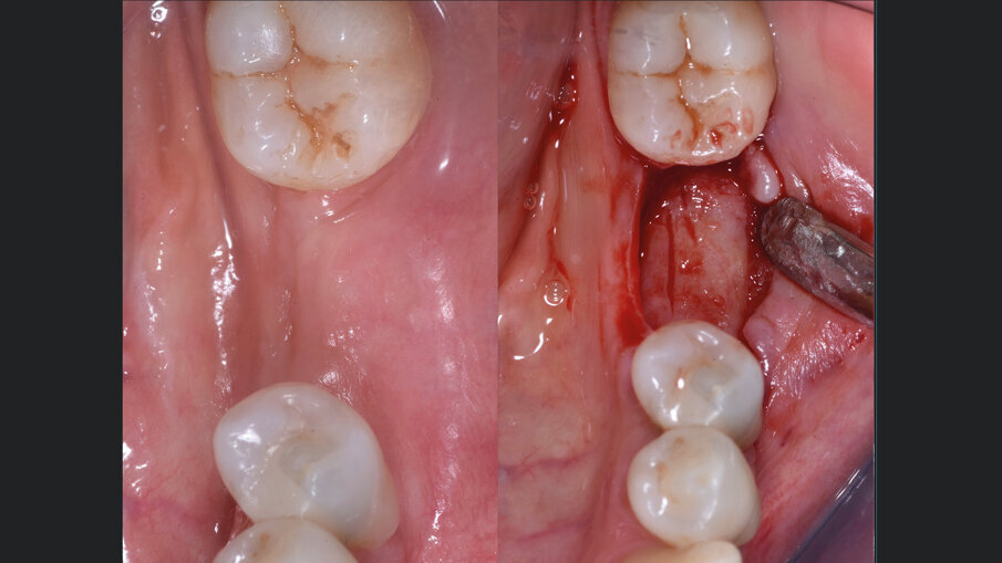 Fig. 5 - A sinistra, l’aspetto ottimale dei tessuti molli a 6 mesi dalla GBR. A destra, la riapertura che mostra la risoluzione dell’atrofia orizzontale e il rimodellamento completo dell’innesto eterologo con osso neoformato.