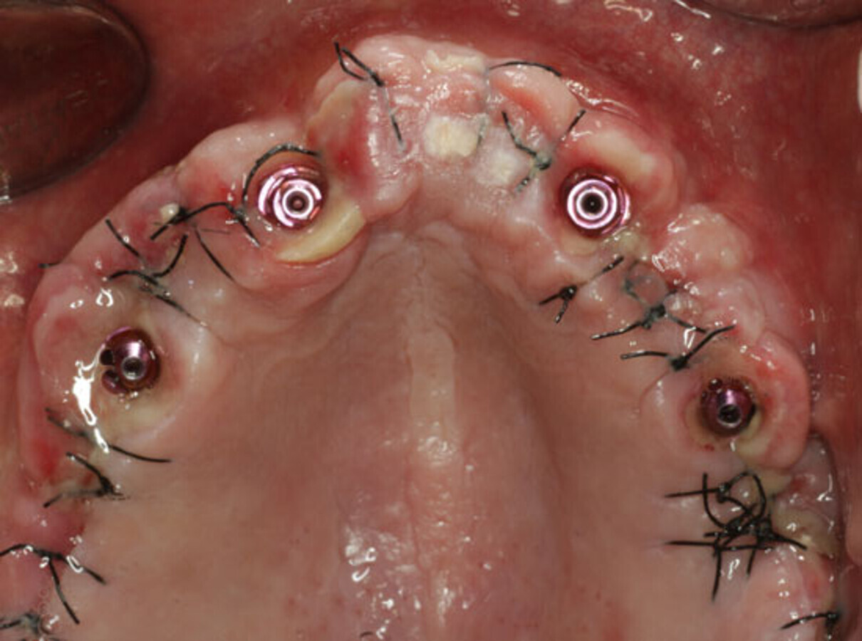 Fig. 23. Imagen oclusal a la semana de la cirugÃ­a, en el momento de la retirada de puntos. ObsÃ©rvese como se va modificando la mucosa gracias a la presiÃ³n controlada de la prÃ³tesis de carga inmediata.