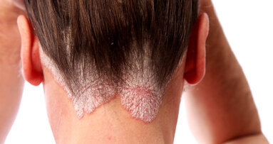 Smoking places psoriasis patients at risk of severe periodontal disease