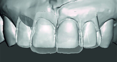 Aesthetic Digital Smile Design: 2-D-/3-D-assisted communication and software design