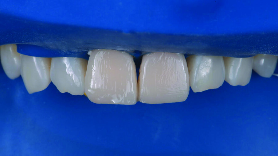 Placement of the second and final layer of 3M™  Filtek™ Universal Restorative A1 shade.
