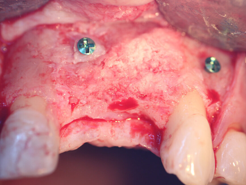 Fig. 17: The healed grafted ridge at 4.5 months following flap elevation demonstrating adequate width facial-palatally to allow implant placement. 