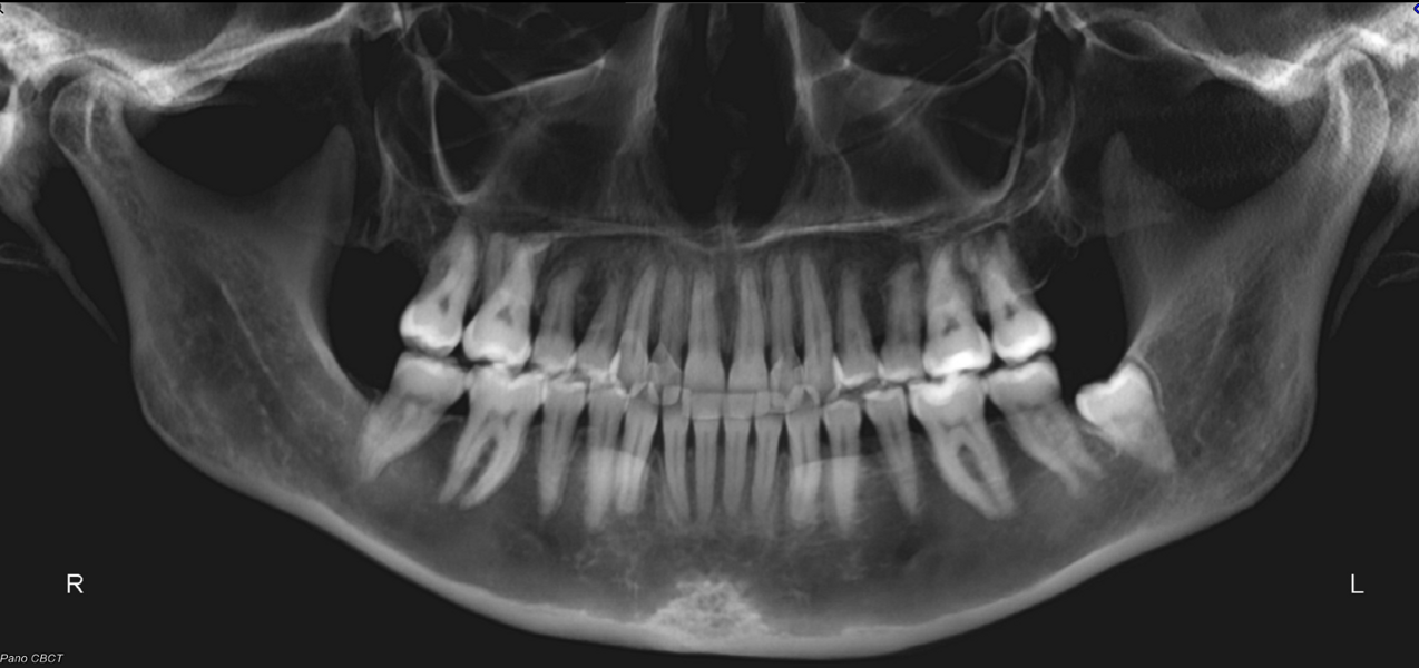 Fig. 54: Post-treatment dental panoramic tomogram.