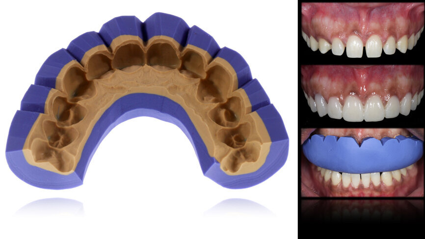 Fig. 47: Mock-up procedures and result in the mouth in order to evaluate the aesthetic relation between the face and the smile.