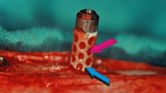 Impianti osteoinduttivi