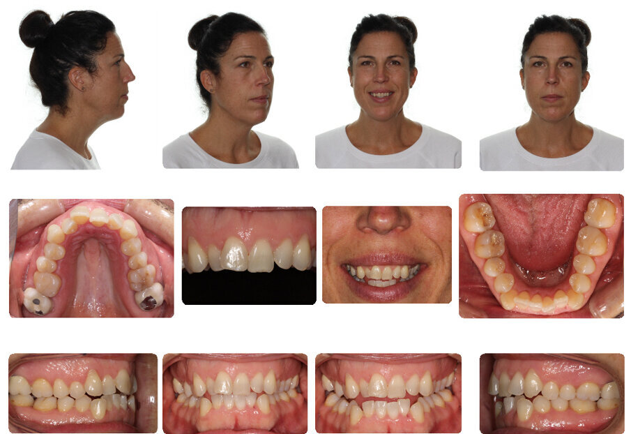 Pre-treatment