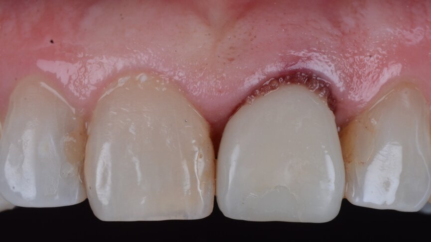 Fig. 27: Temporary crown seated and polished.