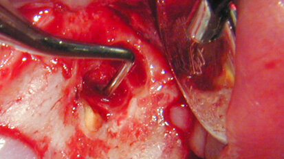 Apical microsurgery: REF materials, techniques (Part 5)