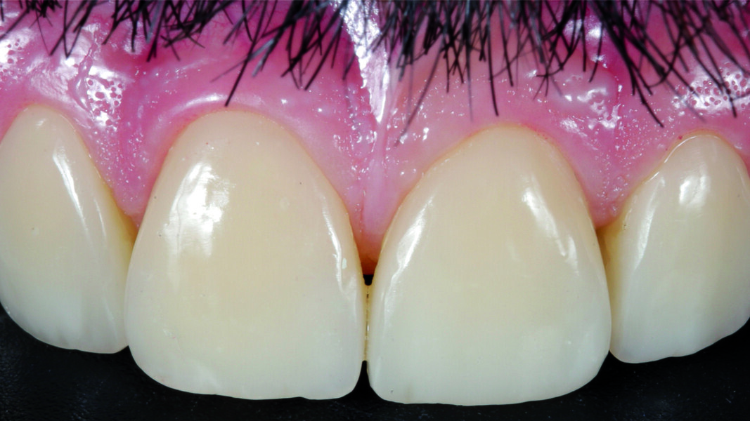 Fig. 18: Final result, frontal view.
