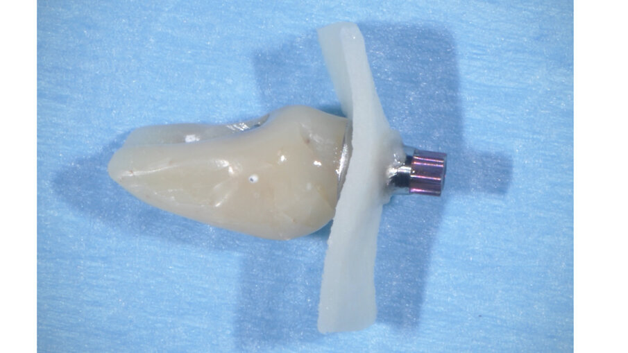 Fig. 6_Matrice dermica suina forata per la stabilizzazione mediante provvisorio.