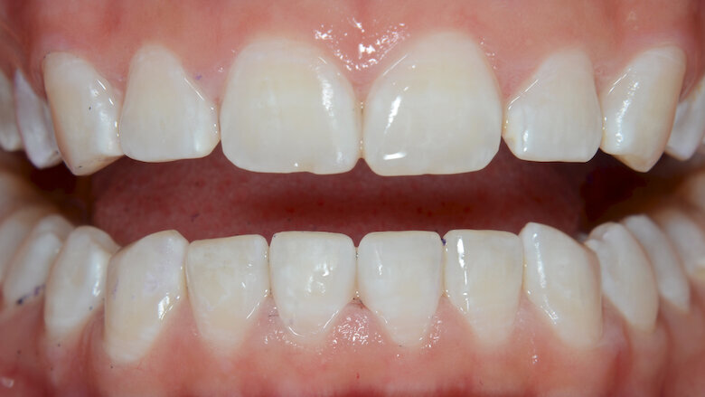 Foto 7. Resultado después de la séptima sesión de microabrasión.
