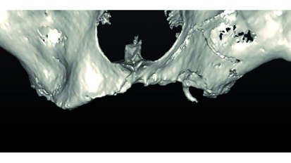 CAD/CAM custom-milled titanium bar for rehabilitation of an atrophic upper jaw