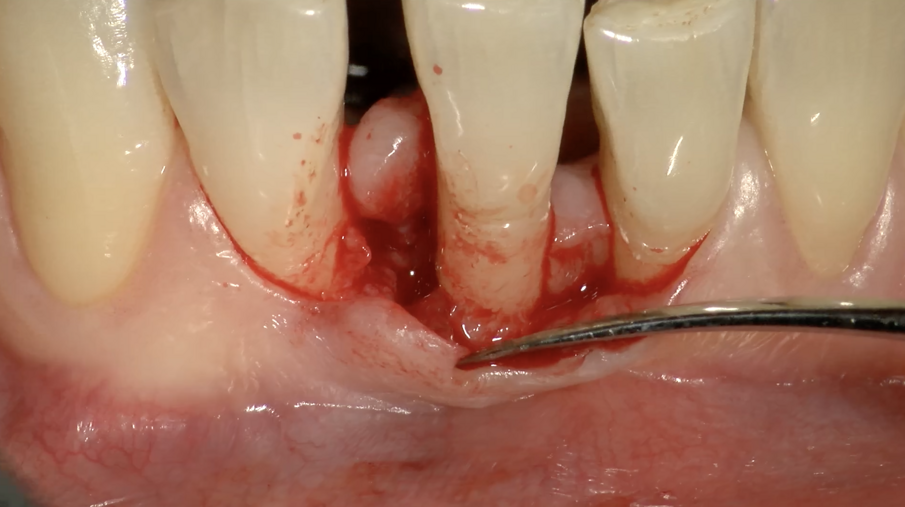Fig. 6d - Lembo sollevato con preservazione papille.