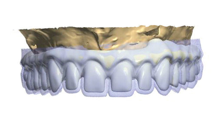 Fig. 4: Scan of the temporary prosthesis (blue color) visible against the design of the construction.