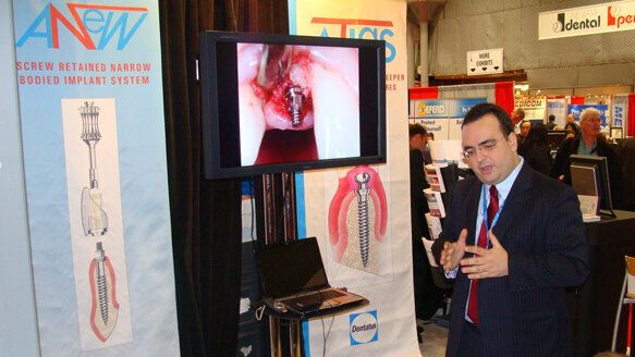 Dentatus makes implants attainable to new populations