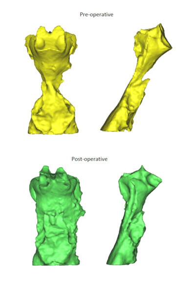 The preoperative and postoperative airway images showing an increase in the airway volume. (Image: Mike Yiu-yan Leung)