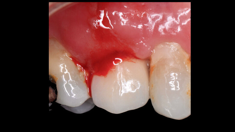 El enemigo invisible en la periimplantitis