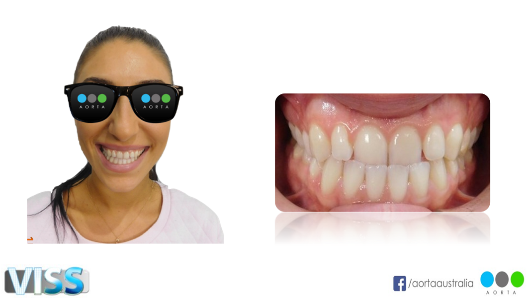 Fig. 41: Patient’s facial photograph pre-treatment during the consultation phase, alongside a close-up view of the patient’s smile.