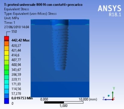 Fig. 10a - Von Mises results referred to the bone at the maximum stress, universal prosthesis.