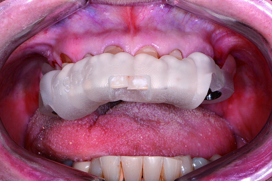 Fig. 3: Tooth-Borne Surgical guide by 3DDX.
