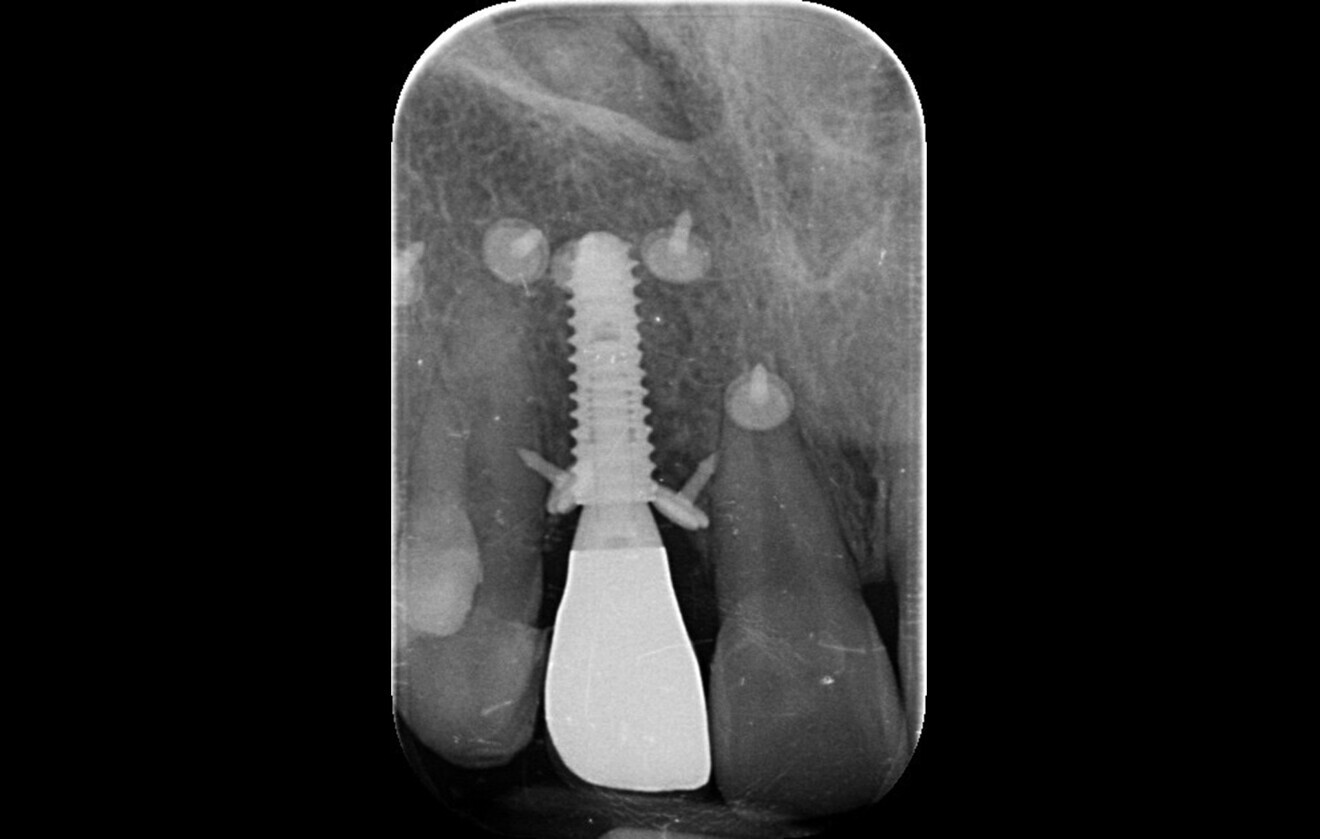 Fig. 5: Post-op intra-oral radiograph after implant placement and vertical guided bone regeneration. 