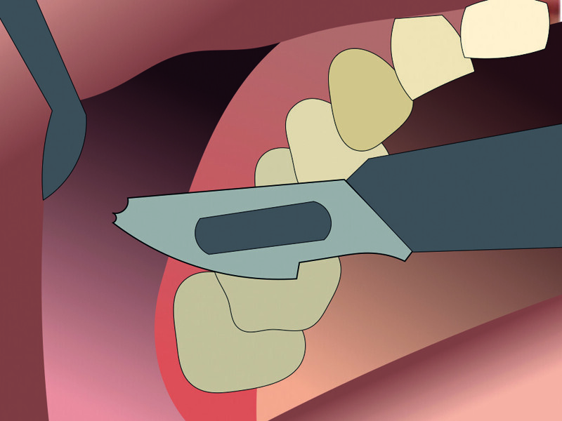 Fig. 9 : Incision au bistouri.