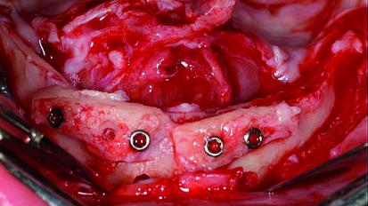Augmentation and implant treatment: Two-stage surgery in the severely resorbed edentulous mandible