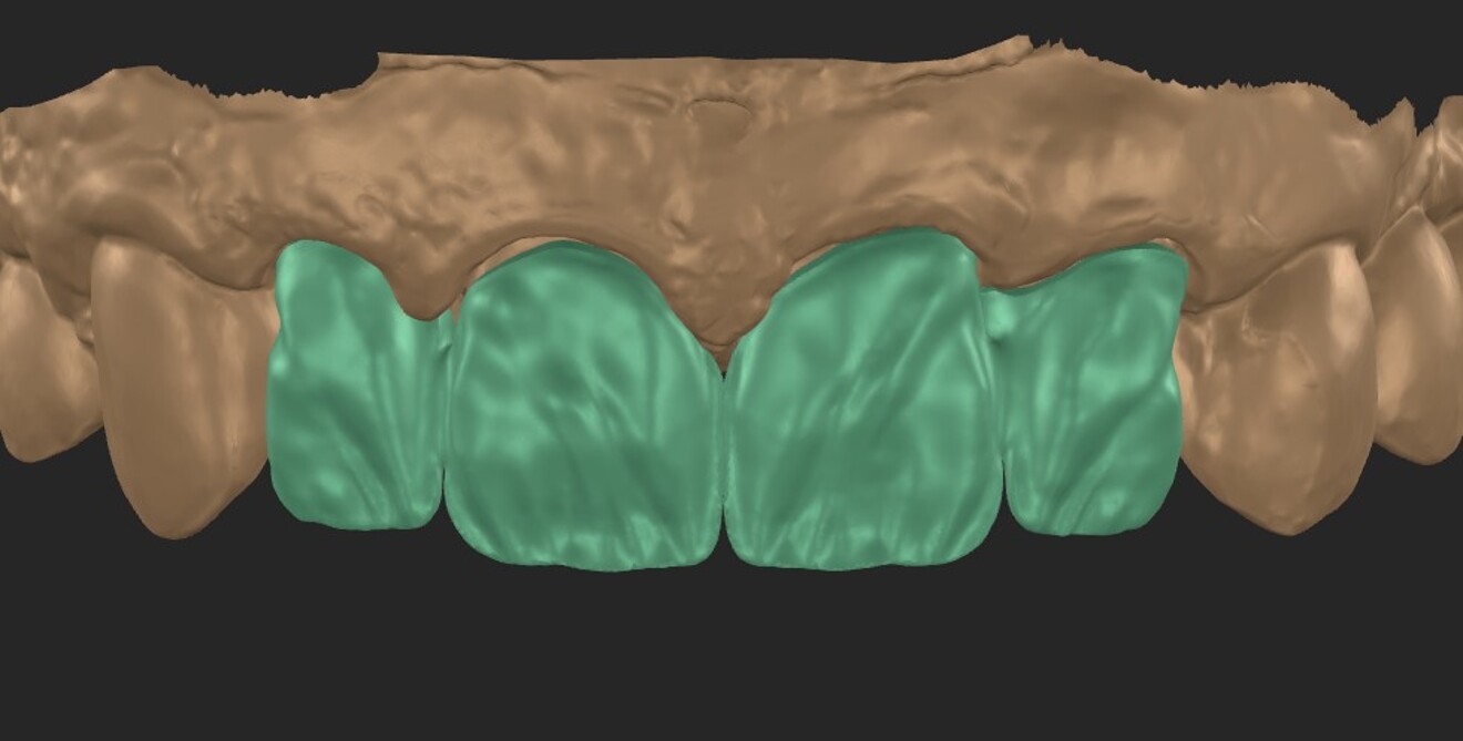Fig. 2: CAD of the zirconia frameworks. Outer contour of the splinted crowns with a detailed surface texture and sufficient room for micro-layering.