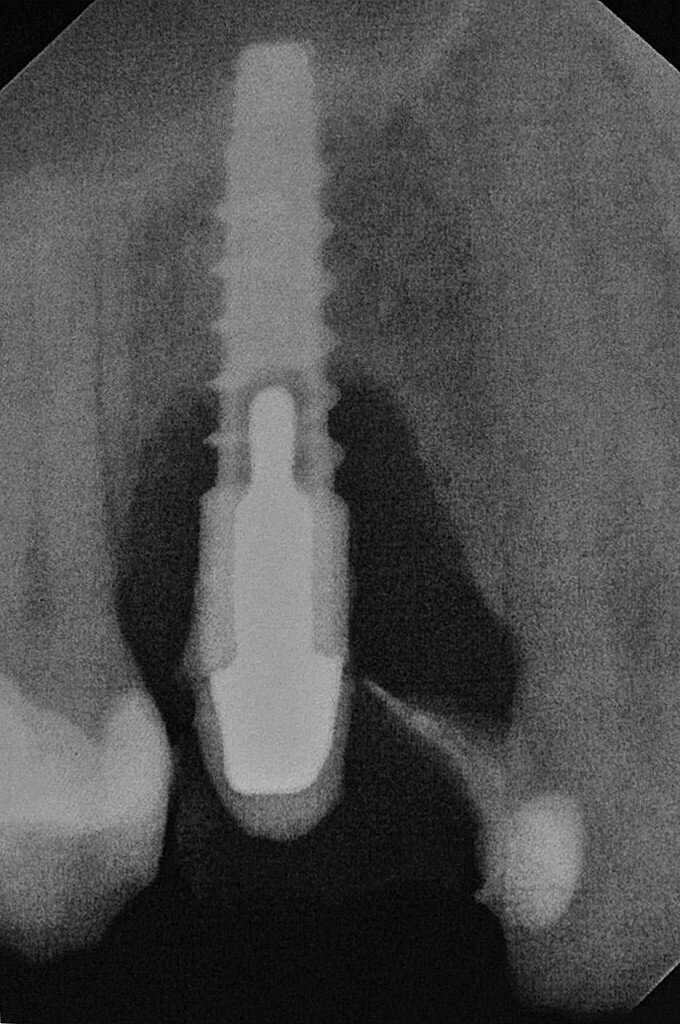 Fig. 2: Radiographic examination of the implant.