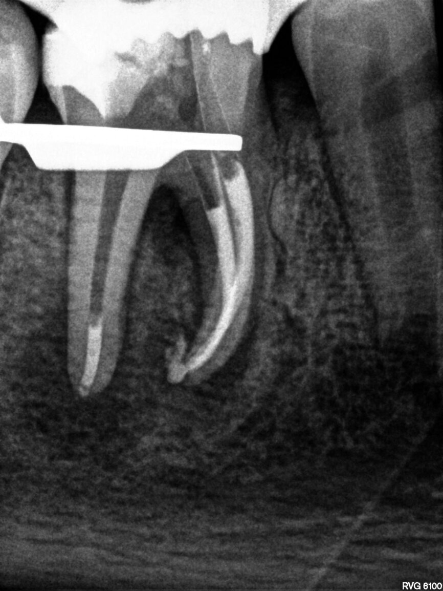 Fig. 7: Control of the obturation before final restoration.
