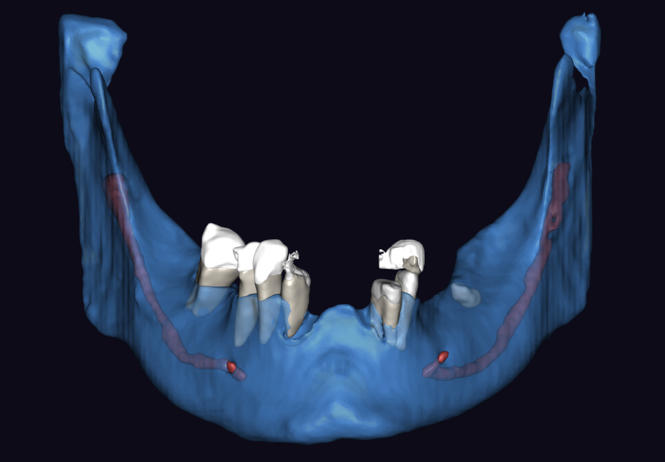 Figs. 3a & b: Segmented CBCT scan (a). Mandibular arch morphology after virtual teeth extractions (b).